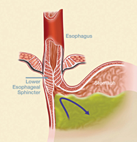 View of a normal lower esophageal sphincter