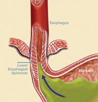 View of a weakened lower esophageal sphincter