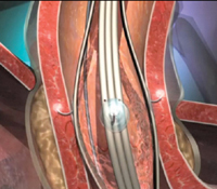 Stretta therapy delivers radiofrequency energy to the lining of the lower esophageal valve. 