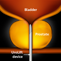 UroLift step1 200