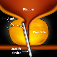 UroLift step2 200