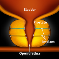 UroLift step3 200