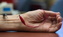Acupuncture shown to reduce blood pressure