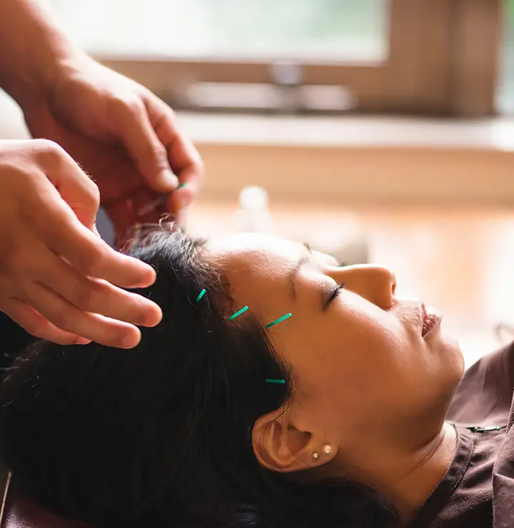 Person lies with acupuncture needles in their head in a calm setting.