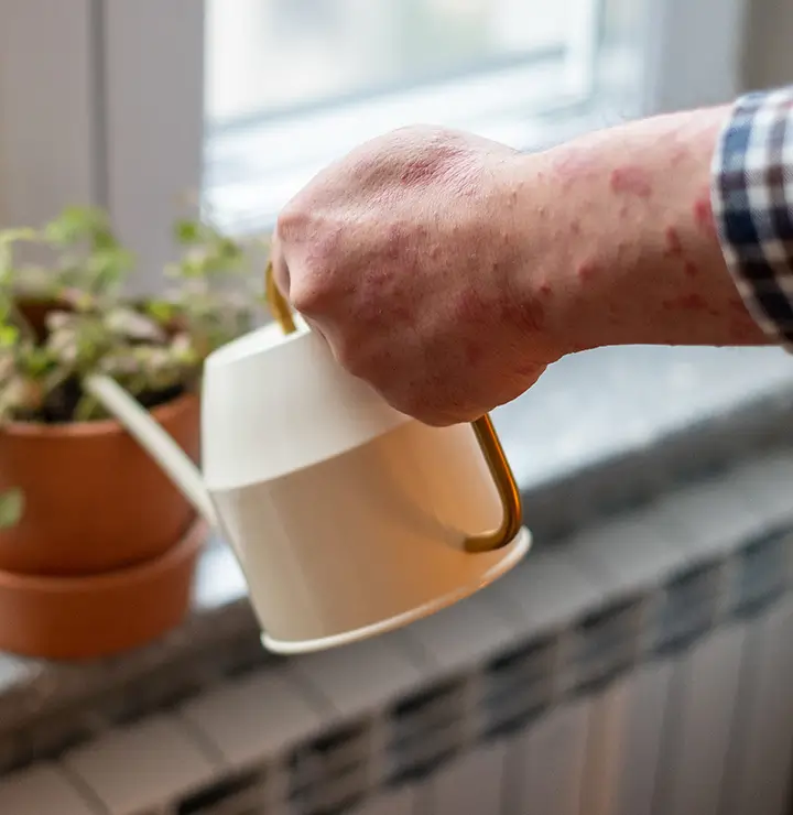 Hand with red skin holding a watering can, pouring water on a potted plant by a window.