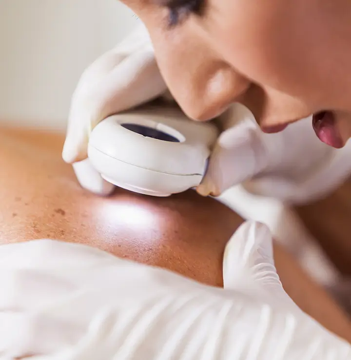 Gloved person uses magnifier to examine a mole during a dermatology check-up.