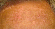 UCI Health vitiligo patient after excimer laser treatment